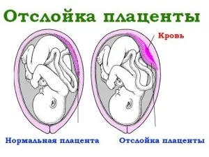 Как съвместим два рога на матката и бременност