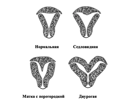 Как съвместим два рога на матката и бременност