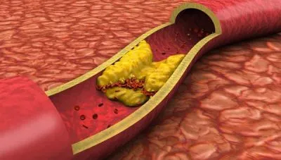 Nestenoziruyuschy atherosclerosis brachiocephalica (artériák) úgy kell tekinteni