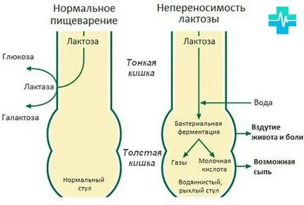 непоносимост към лактоза