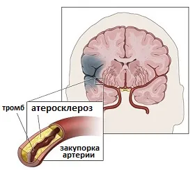 Műveletek a nyaki verőér - tünete info