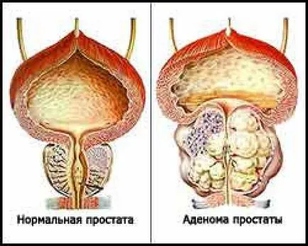 Основните признаци и симптоми на простатит и ВРН болка, повишена температура, секреция, сърбеж,