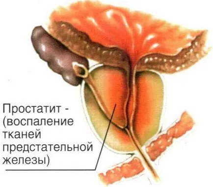 Основните признаци и симптоми на простатит и ВРН болка, повишена температура, секреция, сърбеж,