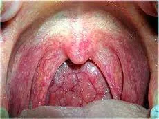 Perche și dureri în gât aveți simptome de faringita!