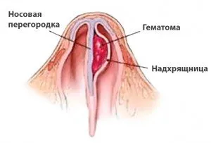 Перфорация на носната преграда - да са здрави