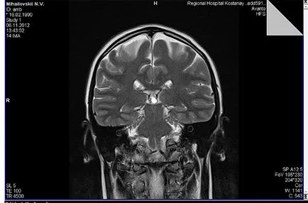 Pinealoma tumor a tobozmirigy - osisanie és a kezelés