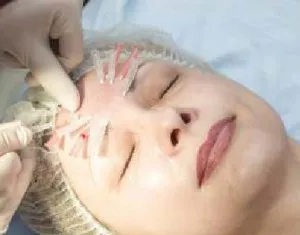 Ce bine mezoniti, materiale de umplutură, Botox sau bioreinforcement