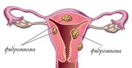 Ce este fibromului uterin, cauzele sale, simptome, tratament