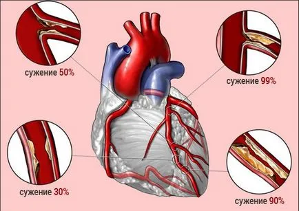 Какво е сърдечно съдови недостатъчност - симптоми и лечение, първа помощ