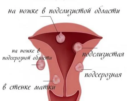 Ce este fibromului uterin, cauzele sale, simptome, tratament