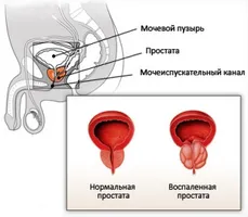 Ajută miramistin cu prostatita