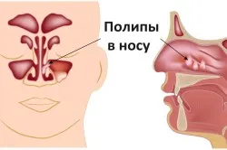 Носни полипи лечение народни средства