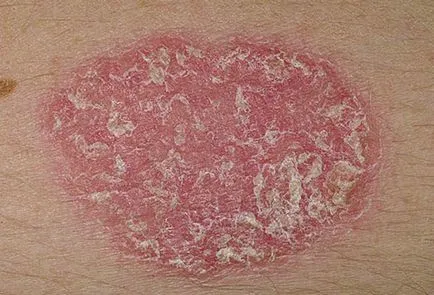 Okai Psoriasis