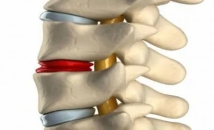 Protruzia discului spinării, care este și cum să trateze boala