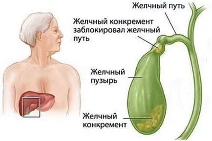 Предотвратяване на панкреатит какви правила трябва да се спазват