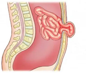 Hernia ombilicala simptomelor adulți sunt tratate fără intervenție chirurgicală