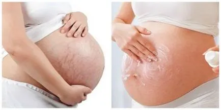 Terhességi csíkok a terhesség alatt vagy megszüntetésére profilaktirovat