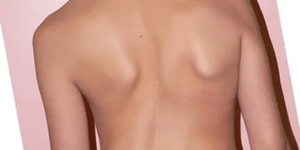 Scoliosis 1 fok fotók és videók gyakorlatok, torna és gyógytorna