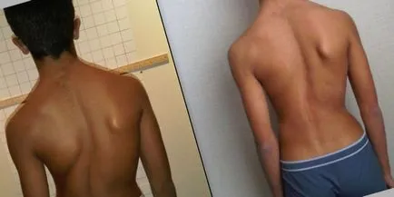 Scoliosis 1 fok fotók és videók gyakorlatok, torna és gyógytorna