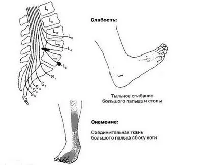 Sindromul cauda equina este ceea ce este, o persoană care prezintă simptome, tratament, cauze și gimnastica