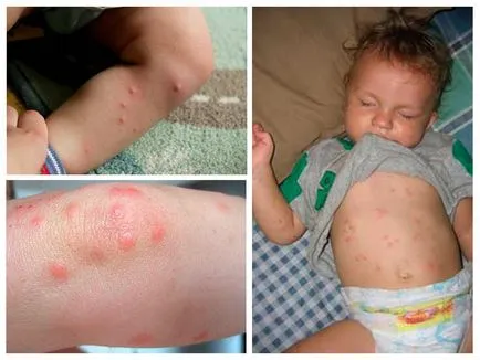 Симптоми и фото дървеници ухапвания при децата, възникнали грешки в детската градина