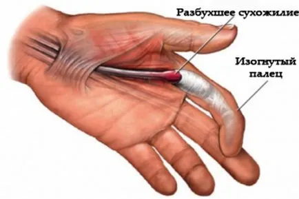 Констриктивен сухожилие на палеца, крак, коляно патела лечение