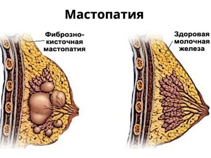 Stella de la mastita dacă să înceapă tratamentul cu