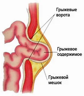 hernie strangulată cauze, simptome, tratament si tehnici de ingrijire de urgenta pentru pacient
