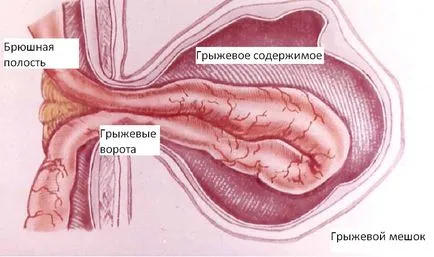 hernie strangulată - Tratamentul, cauze, simptome, prevenirea