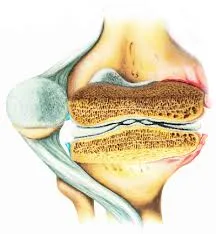 Válassza ki a legjobb kezelés gonarthrosis - az alkalmazott osteoarthritis, kezelése népi