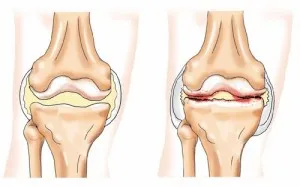 Alege cel mai bun tratament pentru osteoartrita a genunchiului - metodele de tratament al osteoartritei, tratamentul popular