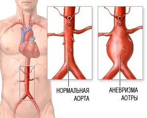 Uzi коремната аорта