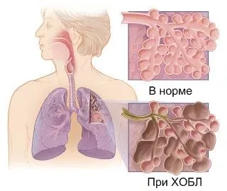 COPD - okai, tünetei