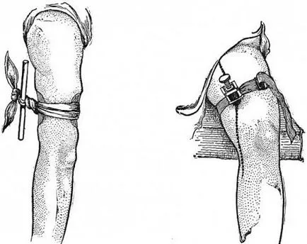 Временно начин да се спре кървенето - артериални и венозни