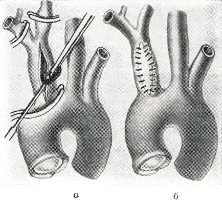 Tratamentul chirurgical al aterosclerozei - tratament de inima