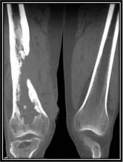 Krónikus hematogén osteomyelitis