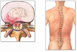 Diffúz posterior kiemelkedés a porckorong