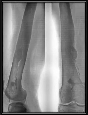 Krónikus hematogén osteomyelitis