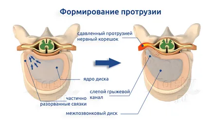 Diffúz posterior kiemelkedés a porckorong