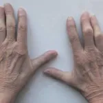 Dermatomyositis és polymyositis fotó, tünetei és kezelése