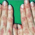 Dermatomyositis és polymyositis fotó, tünetei és kezelése