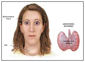 Деформацията на щитовидната жлеза как и защо това се случи