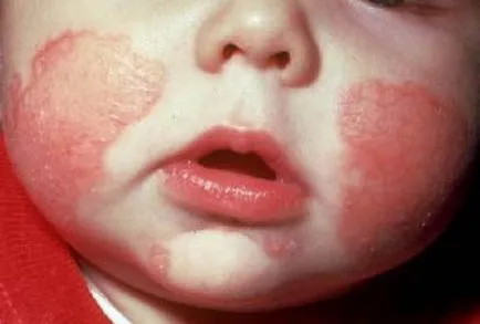Детски псориазис симптоми, фото, лечение на народната медицина