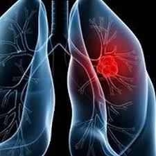 Инфекция на диагнозата на белите дробове аспергилоза и лечението