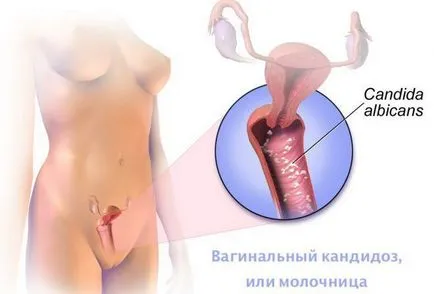 Pruritul in menopauza vagin remedii de tratament populare