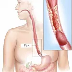 nyelőcső adenocarcinoma - a rák kezelésére Izraelben, Izrael Cancer Center №1