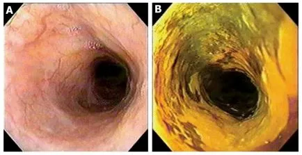 Adenocarcinomul de prognostic esofagian, tratamentul, prevenirea