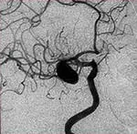 Anevrismelor si accident vascular cerebral - Tratamentul Inimii