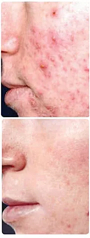 Készülék kezelése acne, acne, acne otthon 