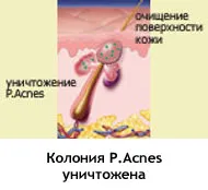 Készülék kezelése acne, acne, acne otthon 